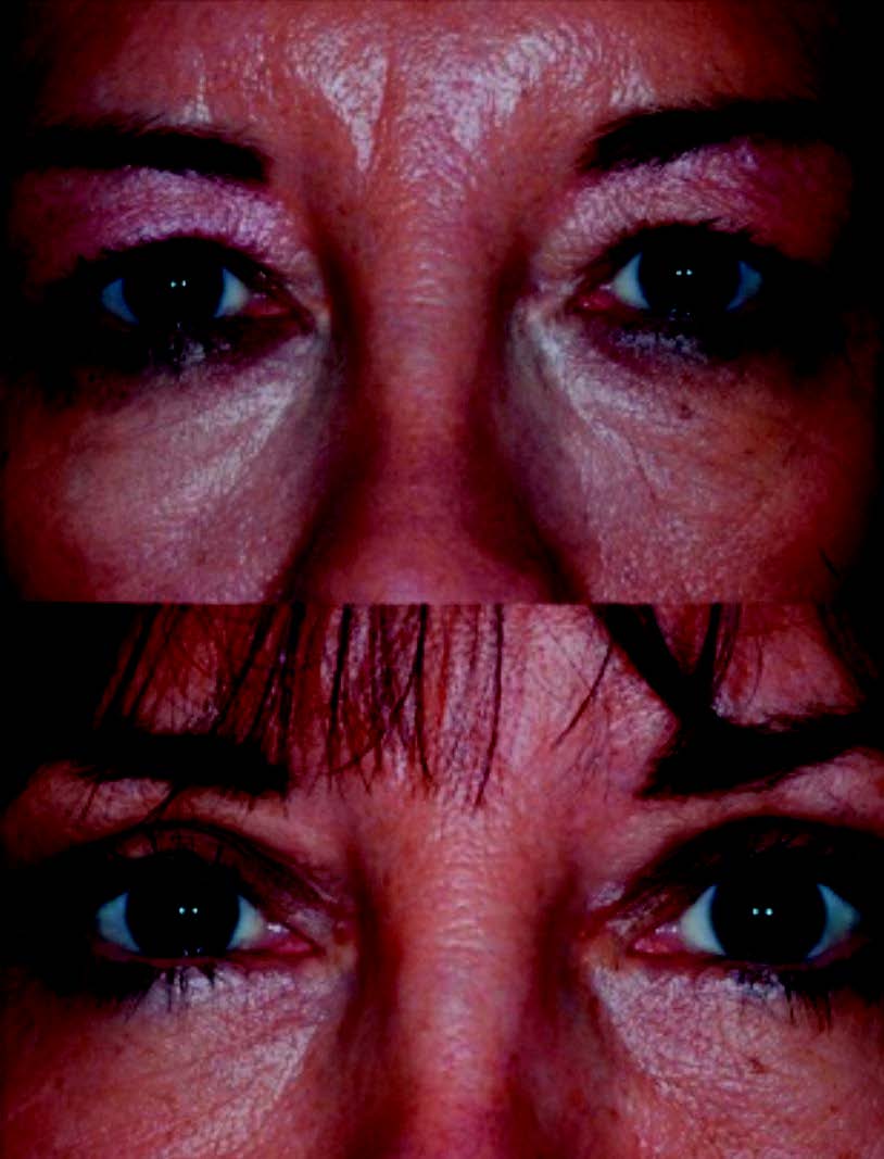 Figure 3. Résultat d’une blépharoplastie supérieure avec réfection du pli palpébral.
