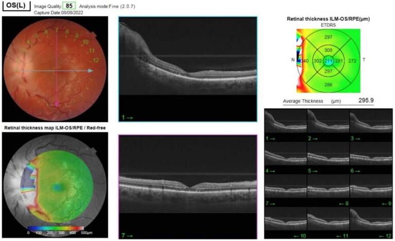 Figure 6. OCT maculaire de l’œil gauche, assèchement de l’œdème maculaire (Topcon Dri OCT Triton plus – CHBA Vannes, service d’ophtalmologie).
