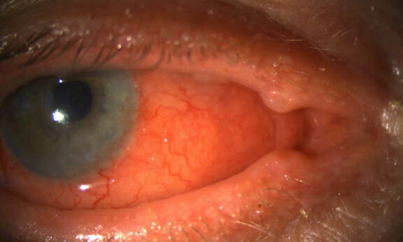 Figure 1. Blépharo-conjonctivite induite par Dupilumab (DIODS).
