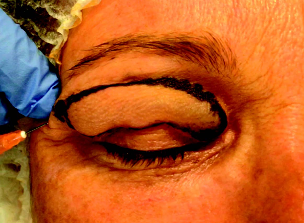 Figure 9. Infiltration de la paupière supérieure et bloc supraorbitaire.
