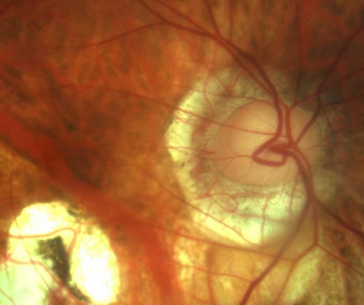Figure 1. Œil myope de – 6 D avec glaucome évolué.
