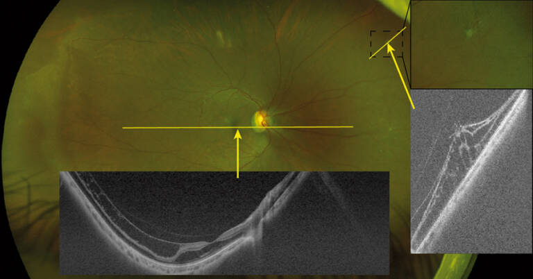 Figure 2. Fovéoschisis myopique chez une femme de 33 ans. L’OCT permet d’imager à la fois la fovéa avec une coupe de 23 mm (en inférieur de l’image), mais aussi un tuft rétinien périphérique (à droite de l’image).
