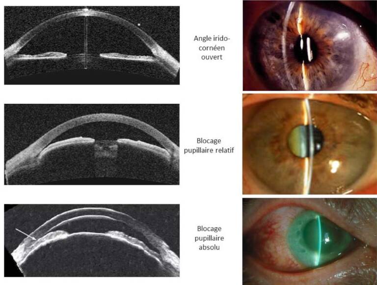 Figure 1. Mécanismes des glaucomes par fermeture de l’angle : blocage pupillaire.
