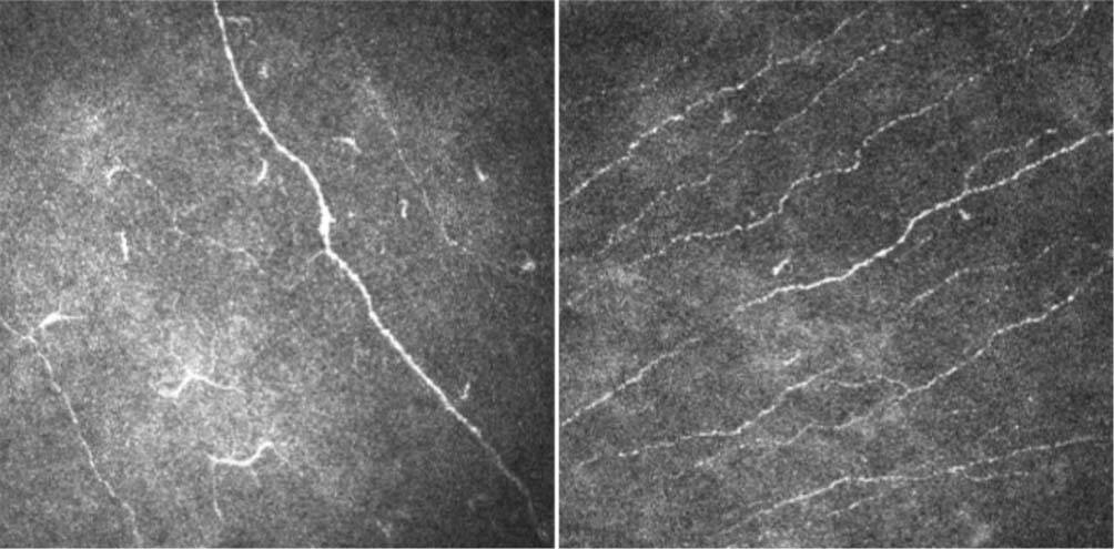 Figure 2. Diminution de la densité des nerfs du plexus sous-basal chez un patient avec un syndrome de Gougerot-Sjögren (à gauche) vs sujet contrôle sain (à droite). 
