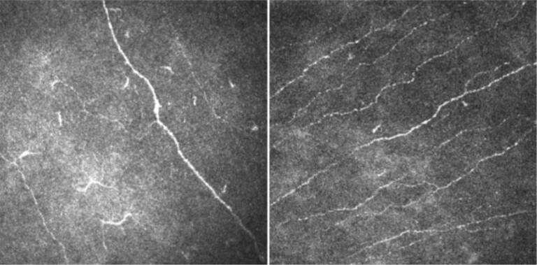 Figure 2. Diminution de la densité des nerfs du plexus sous-basal chez un patient avec un syndrome de Gougerot-Sjögren (à gauche) vs sujet contrôle sain (à droite).&nbsp;
