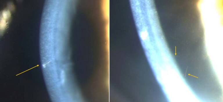 Figure 1. Photos de la lampe à fente : poils intracornéens dans le stroma (flèches jaunes).
