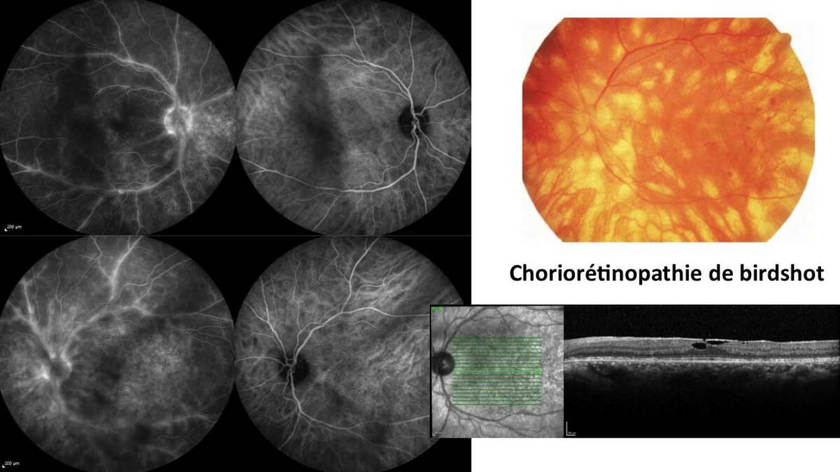 Figure 4. Imagerie multimodale dans une choriorétinopathie de Birdshot avec en RNM de nombreuses taches blanches vitiligeuses ; l’OCT objective une membrane épirétinienne ainsi qu’un OM sous la forme d’un œdème intrarétinien fovéaire ; la FLUO (clichés de gauche) objective une vascularite veineuse des gros troncs associée à une capillarite des 2 yeux ; l’ICG visualise les granulomes choroïdiens sous la forme de nombreuses taches hypofluorescentes en ICG en regard des taches blanches en RNM ; à noter que la présence des taches blanches n’est pas indispensable au diagnostic positif de la choriorétinopathie de Birdshot, à la différence des taches hypofluorescentes en ICG chez un patient porteur d’un HLA A29.
