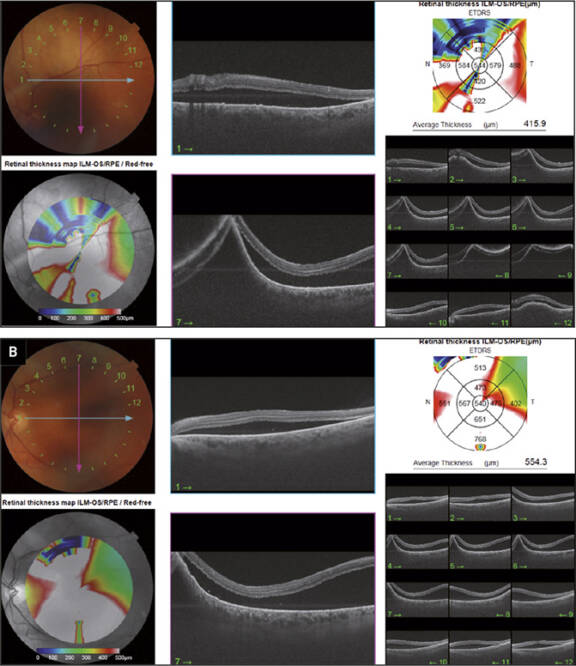 Figure 2. OCT passant par la lésion (A) et OCT maculaire (B) de l’œil gauche, décollement sous-rétinien atteignant la macula (Topcon Dri OCT Triton plus – CHBA Vannes, service d’ophtalmologie).
