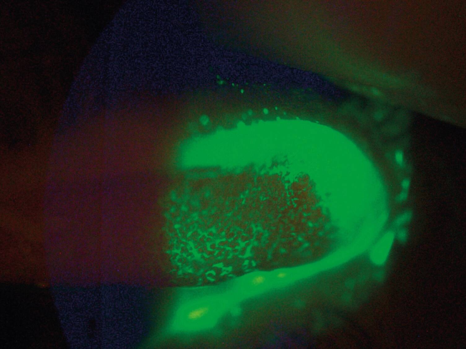 Figure 8. Lid Wipper Epitheliopathy supérieur gauche, associé à des follicules palpébraux, expliqué par les frottements mécaniques de la paupière sur une surface oculaire (et une lentille) « sèche ».
