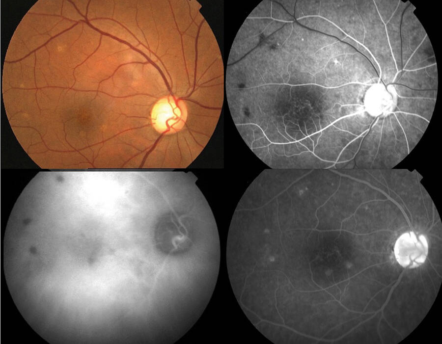 Figure 2. Photographie du fond d’œil, angiographie rétinienne à la fluorescéine et à l’ICG de tubercules de Bouchut.&nbsp;
