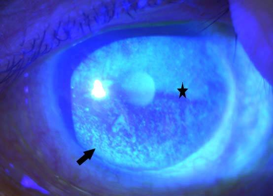 Figure 8. Examen en lumière bleue après instillation de fluorescéine et retrait de la lentille sclérale. Il existe une kératite en nasal inférieur et un aspect « marécageux » sur le reste de la cornée.
