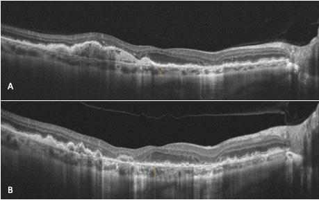 Figure 3. Patiente de 65 ans avec une DMLA atrophique sans atteinte fovéolaire centrale du côté droit. A. Épaisseur choroïdienne initiale avant PBM (140 microns). B. Épaisseur choroïdienne 32,4 mois après (145 microns). À noter une diminution du DEP drusénoïde avec augmentation de l’atrophie géographique avec une épargne fovéolaire centrale conservée.

