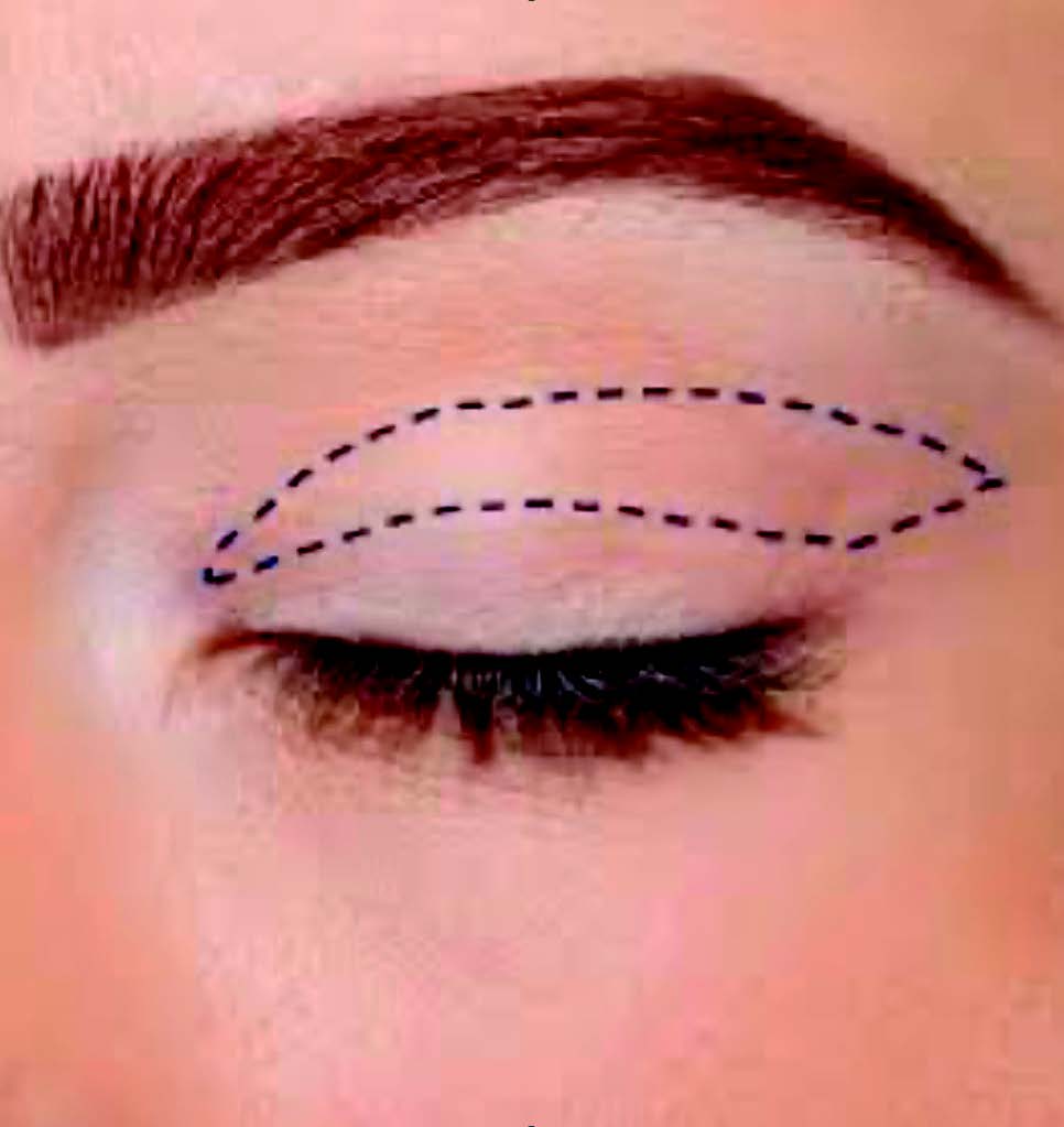 Figure 1. Dessin préopératoire d’une blépharoplastie supérieure.
