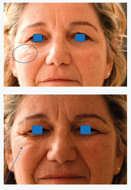 Figure 6. Manœuvre clinique de clignement forcé. Justification d’un lifting malaire.
