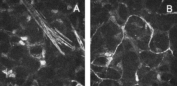 Figure 4. Images retrouvées en microscopie confocale des troncs stromaux 6 mois après un Smile ou un Lasik. Le processus de régénération n’est pas encore terminé et les troncs stromaux apparaissent défasciculés (A) ou fins et tortueux (B). 
