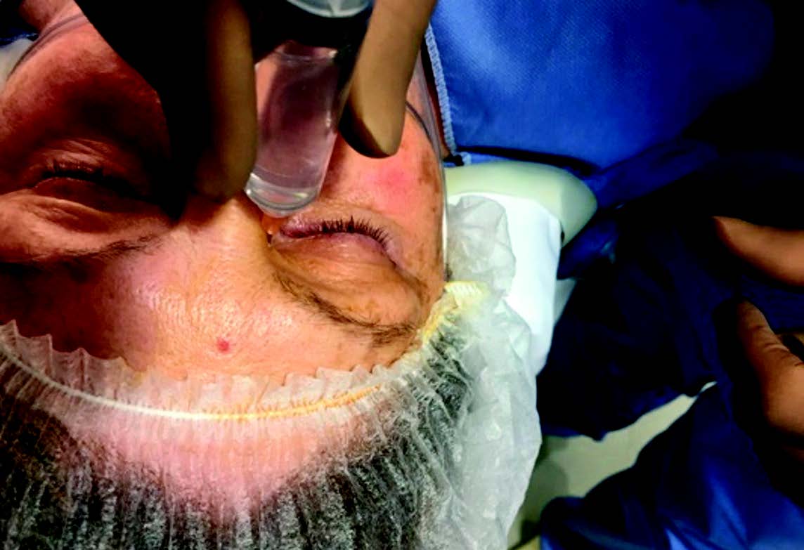 Figure 6. Bloc infratrochléaire.
