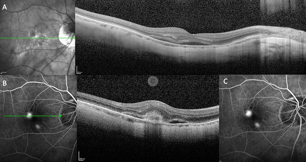 Figure 1. (A) Néovaisseau choroïdien myopique accompagné de fluide sous-rétinien.
(B) OCT B-scan horizontale identifiant du fluide sous-rétinien. Il existe une lésion hyperréflective à bords flous avec une hyporéflectivité postérieure et l’absence d’effraction de l’épithélium pigmentaire. (C) La diffusion tardive à l’angiographie à la fluorescéine confirme le diagnostic.

