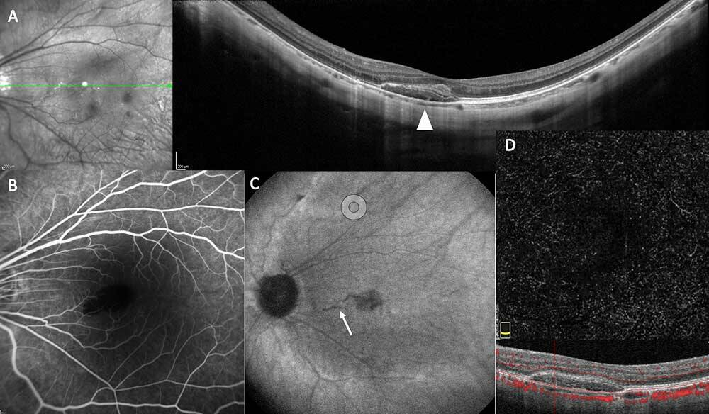 Figure 2. Patiente de 26 ans présentant une baisse d’acuité visuelle avec un décollement séreux rétinien hémorragique visible à l’OCT (A, tête de flèche). Les temps tardifs de l’angiographie à la fluorescéine ne montrent aucune diffusion (B) et  la rupture de la membrane de Bruch est hypofluorescente sur le temps tardif de l’angiographie au vert d’indocyanine (C). L’OCT-A segmentée sur la rétine externe ne montre aucun signal vasculaire (D).
