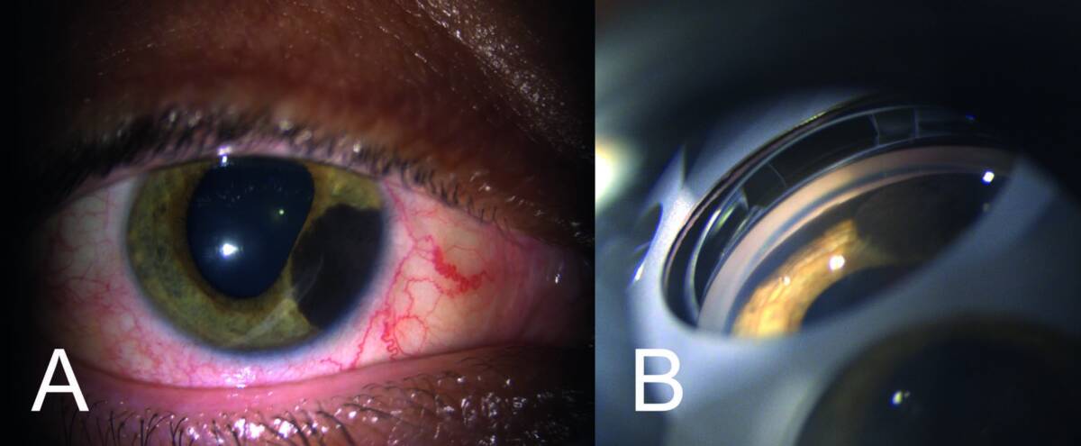 Figure 2. Mélanome irien pigmenté. A. Mélanome de la zone ciliaire de l’iris. B. Il existe un envahissement angulaire de pigments qui fait redouter soit un ensemencement de cellules tumorales, soit des pigments relargués dans le trabéculum.
