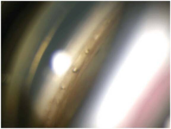 Figure 4. Perforations trabéculaires après une trabéculostomie laser (Elios).
