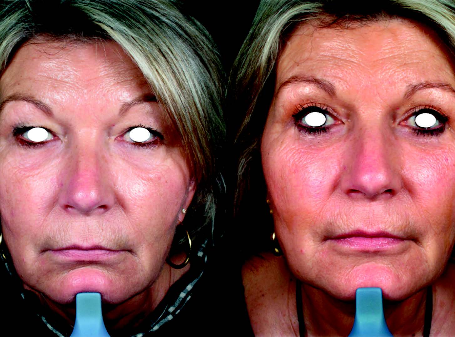 Figure 11. Lifting malaire : résultat Avant-Après.
