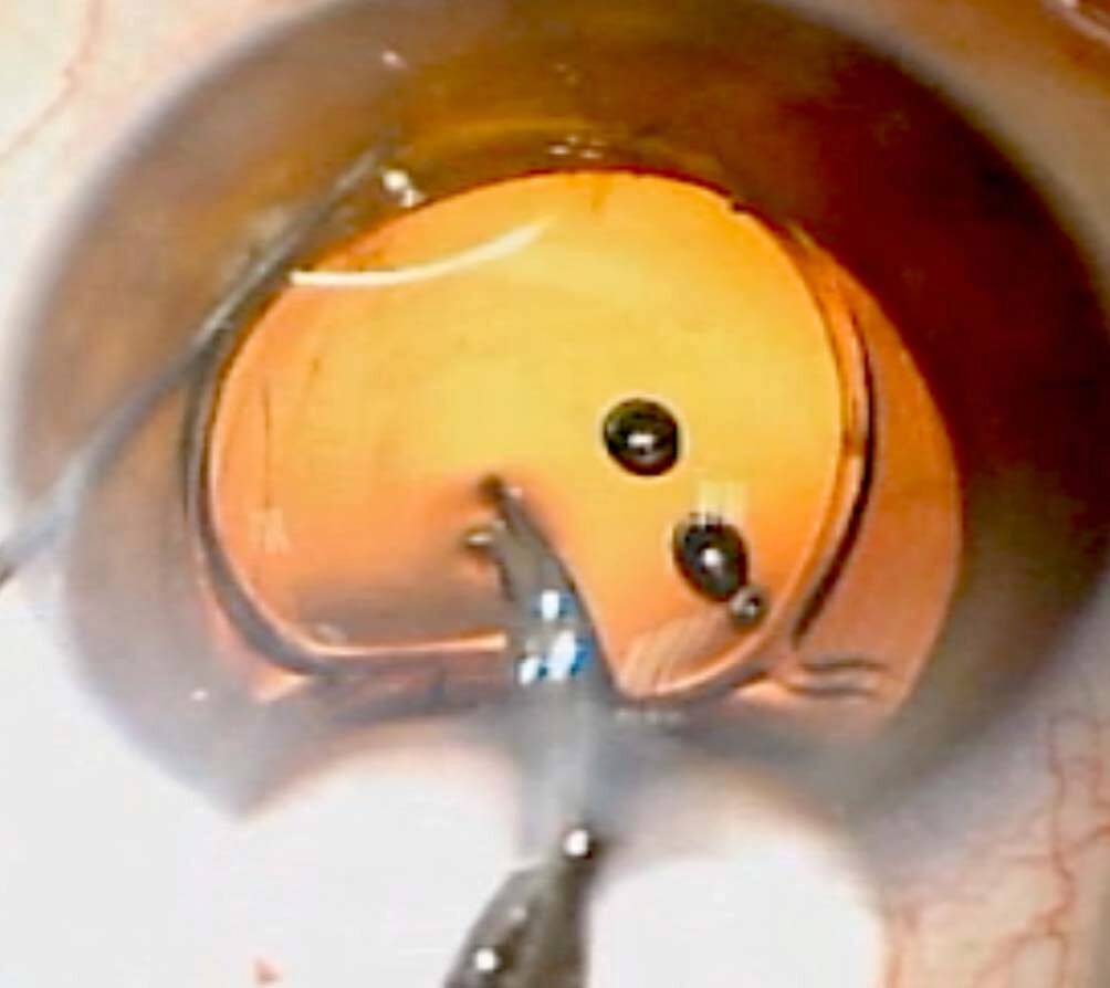 Figure 8. Découpe d’un implant acrylique hydrophile à l’aide des ciseaux de Vannas.
