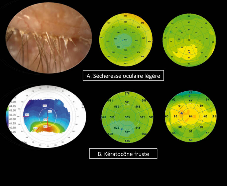 Figure 6. &nbsp;Epithelial thickness map in a patient with moderate dry eye syndrome with BUT of 8 seconds. Significant thinning of the corneal epithelium in the upper part and irregular control distribution of pathological ocular surface is observed.
