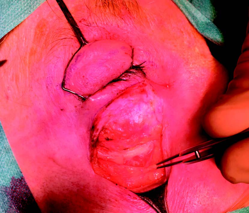 Figure 8. Libération de l’arcus marginalis.
