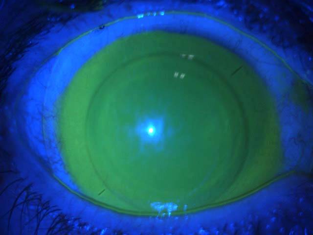 Figure 4. Image LAF avec équipement en lentille SPOT en lumière bleue et fluorescéine.
