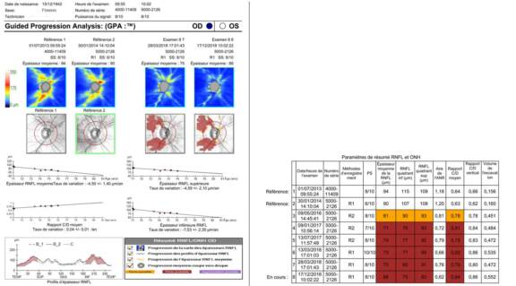 Figure 5. Rapport d’analyse de progression des FNR avec évaluation des pentes de progressions et analyse statistique avec le programme automatisé GPA du Cirrus HD-OCT.
