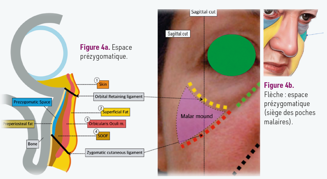 Figure 4a. Espace prézygomatique. Figure 4b. 
Flèche : espace prézygomatique (siège des poches malaires).
