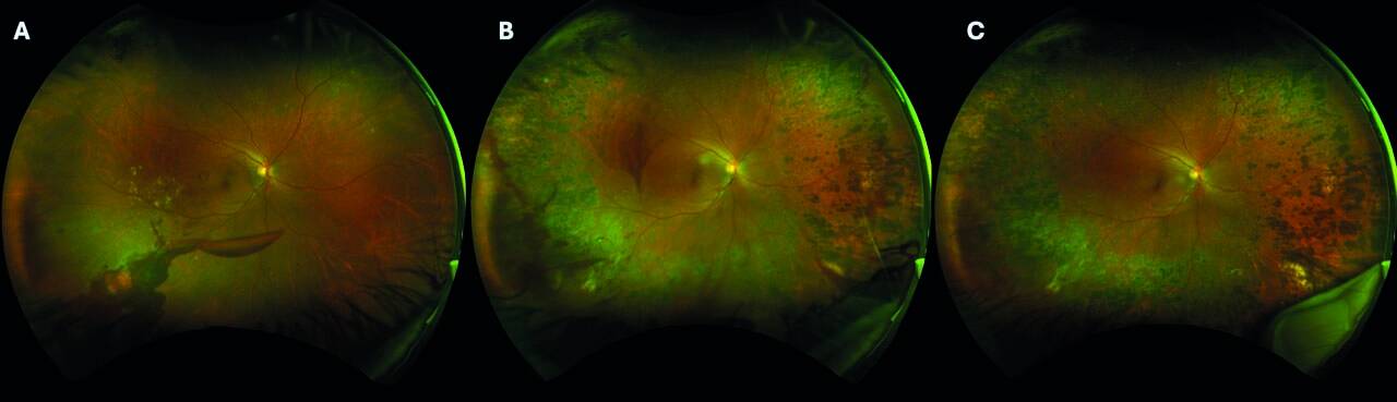 Figure. Patiente de 48 ans prise en charge au CHU de Bordeaux. A. Stade initial : RDPHR (hémorragie rétrohyaloïdienne et intravitréenne). B. PPR effectuée de façon concomitante avec des injections d’anti-VEGF, avec présence d’une hémorragie intravitréenne résiduelle. C. RDP stabilisée avec PPR complète et résolution de l’hémorragie intravitréenne sans chirurgie avec la combinaison PPR + IVT d’anti-VEGF.
