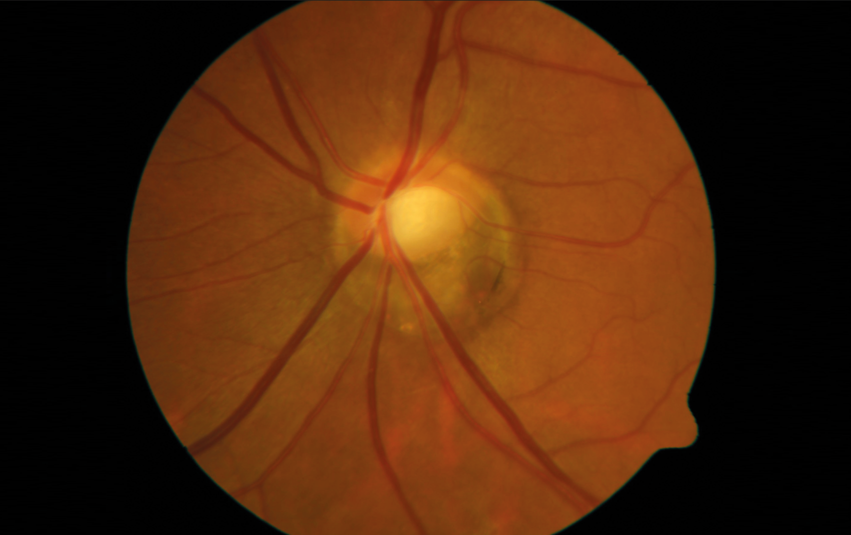 Figure 1. Papille de l’œil gauche présentant une inclinaison typique vers le quadrant temporal inférieur, ainsi qu’une rotation majeure. Notez la vaste zone d’atrophie péripapillaire dans la partie inférieure ; en cas de glaucome, cette zone est généralement la première touchée.
