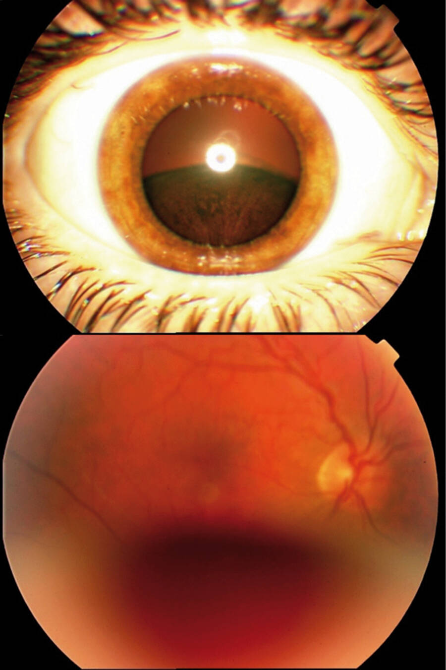 Figure 4. En haut :&nbsp;Tumeur pigmentée inférieure visible en examen lampe à fente. En bas : Lésion très antérieure et inférieure gênant l’examen du fond d’œil (photo : Dr Matet, Institut Curie).

