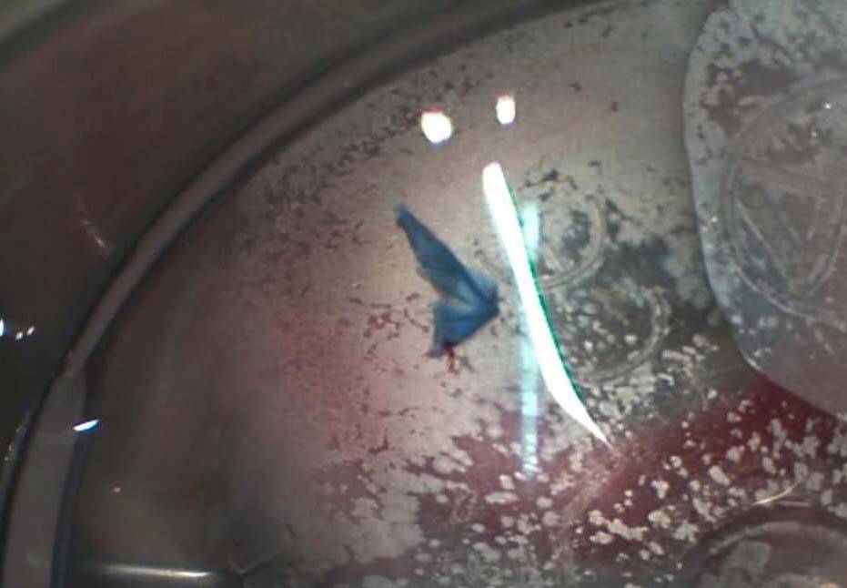 Syndrome de fibrine lors d’une DMEK. Greffon replié sur lui-même en « origami ».
