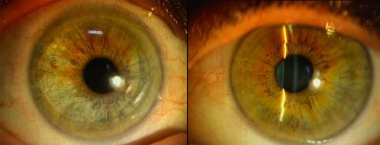 Figure 3. Aspect lampe à fente à 6 mois postopératoires ; l’œil droit est à gauche et montre une cornée claire avec une décoloration irienne perceptible (type TASS), sans préjudice pupillaire. L’œil gauche est à droite pour comparaison (David Touboul).
