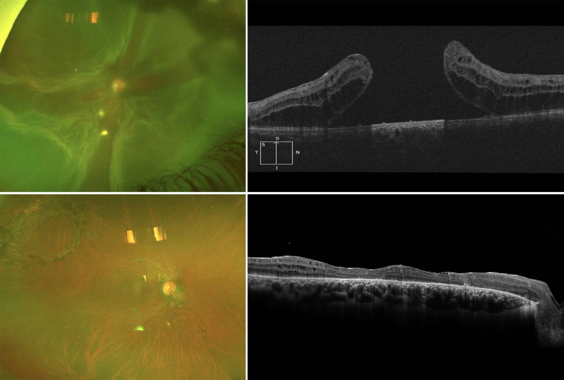 Figure 3. Patient de 36 ans opéré d’un décollement de la rétine par dialyse à l’ora – cryo-indentation – en 2010, puis récidive avec TM, opéré par vitrectomie pelage de MLI et C2F6 en 2012. Réapplication de la rétine sans fermeture du TM. Le patient est ensuite perdu de vue pendant 10 ans et revient avec ce tableau de décollement de rétine total par TM géant (en haut à gauche) mesuré à 2 500 microns plusieurs années auparavant (en haut à droite). Il est réalisé une autogreffe de rétine avec C3F8 pour combler le trou et réappliquer la rétine. L’aspect anatomique postopératoire est satisfaisant, avec un site de prélèvement en temporal supérieur (en bas à gauche) et un greffon en continuité avec la rétine receveuse (en bas à droite). L’acuité est à CLD. 
