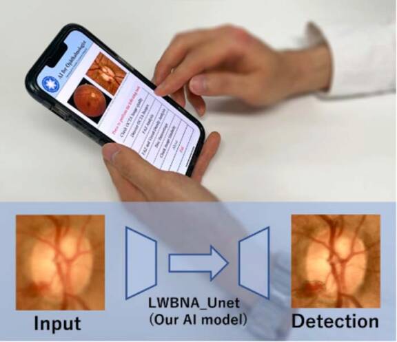 Intelligence artificielle pour l’œil : ce modèle détecte rapidement et précisément des anomalies liées à des maladies oculaires, et ce à partir d’un dispositif à ressources limitées, comme un smartphone.
Crédit : Sharma et al.
