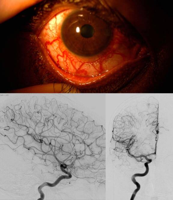 Figure 2. Hypertonie et glaucome unilatéral de l’œil droit chez un patient de 30 ans connu depuis 5 ans. L’examen retrouve une dilatation des vaisseaux épiscléraux, évocatrice d’un obstacle posttrabéculaire. L’IRM a permis d’éliminer une tumeur gênant le drainage veineux et n’a pas retrouvé de fistule. Une angiographie cérébrale a dû être réalisée pour confirmer l’absence de fistule durale, dont le traitement aurait permis de mieux contrôler le glaucome. Certaines fistules durales peuvent se boucher spontanément et laisser de manière séquellaire une dilatation des vaisseaux épiscléraux et un glaucome qui s’est autonomisé.&nbsp;
