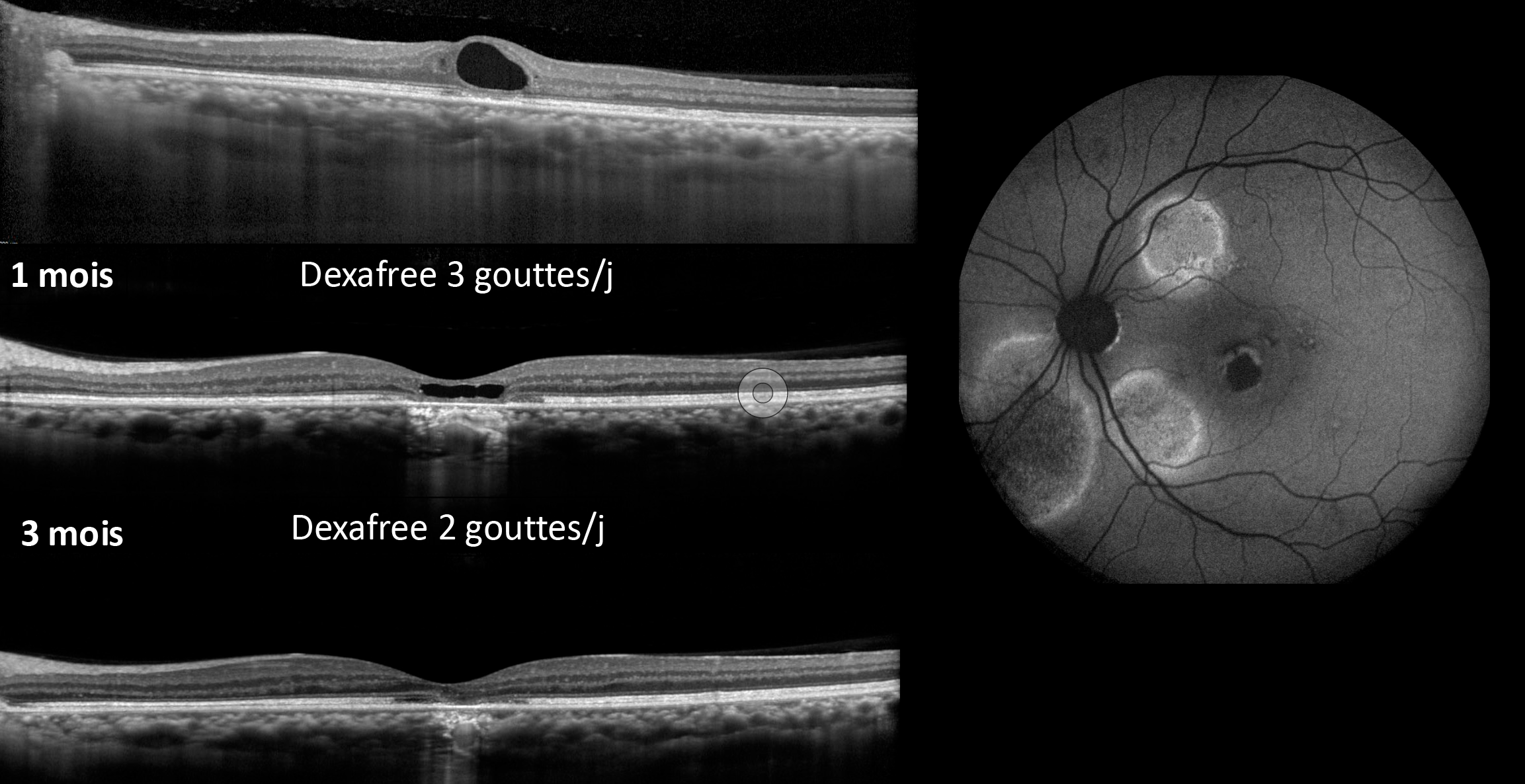Figure 2. Exemple de patient avec une CRSC avec une plage d’atrophie de l’épithélium pigmentaire bien visible en autofluorescence. Les kystes intrarétiniens en regard de l’atrophie ont régressé avec un traitement par collyres de dexafree.
