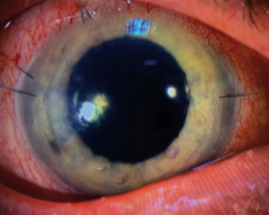 Figure 3. Photo en lampe à fente à J5 postopératoire ; OD montrant un greffon collé et déjà bien clair, la pupille est dilatée par l’atropine prescrite 48 heures en postopératoire, les sutures seront retirées à 1 mois.
