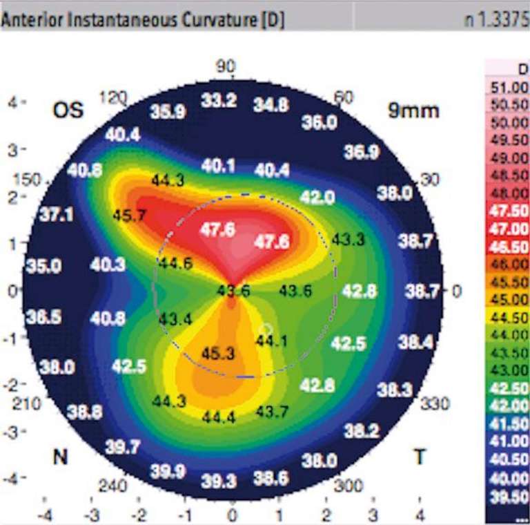 Kératocône et lentille souple hydrophile