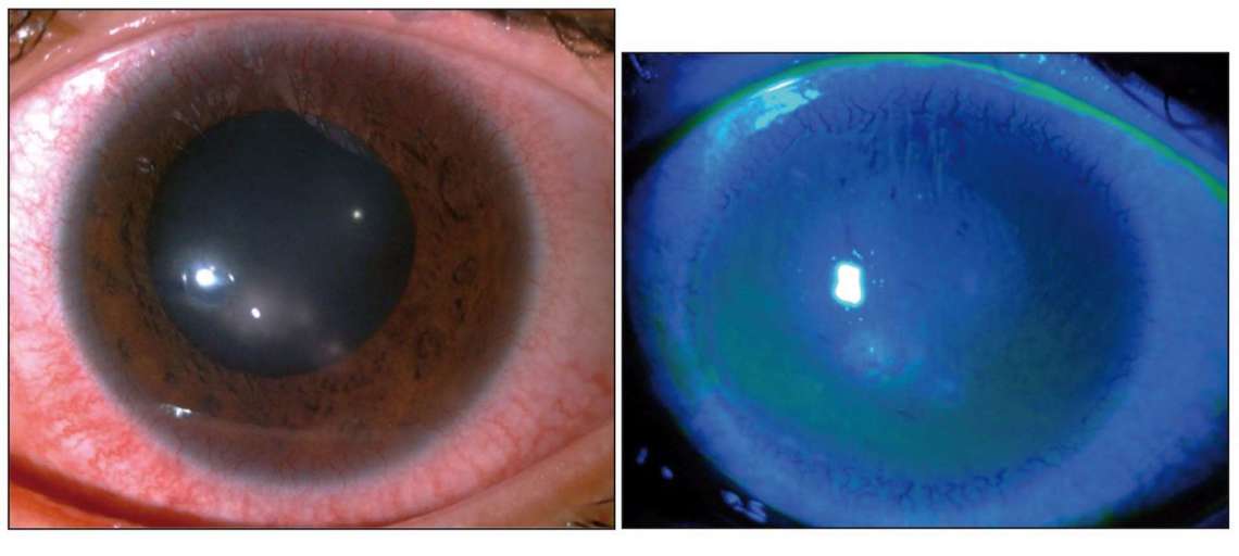 Figure 5. Kératite à staphylococcus aureus associée à une insuffisance limbique chez une patiente porteuse souvent nocturne de lentilles de contact souples hydrophiles mensuelles.
