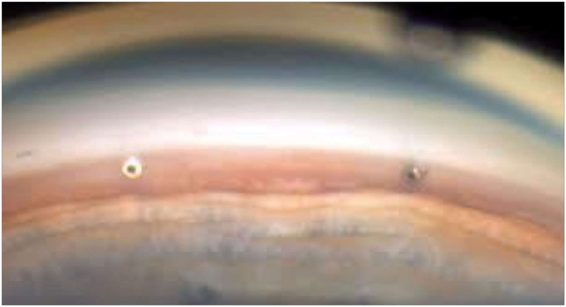 Figure 2. Vue gonioscopique après l’insertion dans le quadrant nasal inférieur de 2 drains iStent inject. 
