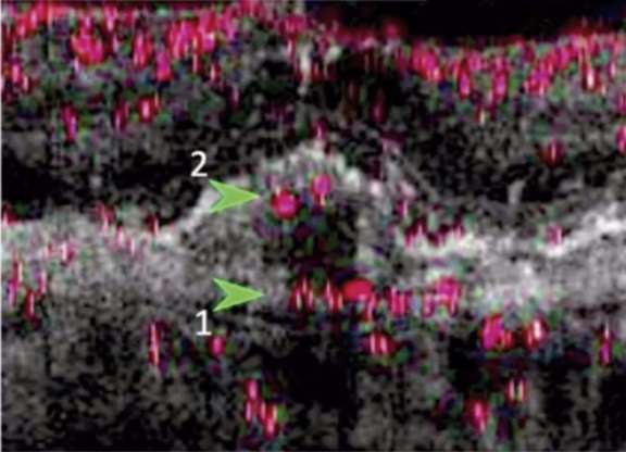Figure 1. Coupe d’OCT B-scan avec signal de flux (« flow overlay ») : deux signaux de flux sont identifiés au sein d’un néovaisseau choroïdien de type 1.
