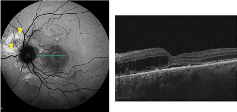 Figure 3. Patient présentant un syndrome de pachychoroïde péripapillaire ; A. Cliché en ­autofluorescence de l’œil gauche montrant une hyperfluorescence à disposition péripapillaire (flèches jaunes) ; B. SD-OCT maculaire du même œil (la ligne verte indique la ­hauteur de coupe) mettant en évidence du fluide ­intra- et sous-rétinien en interpapillo-maculaire.
