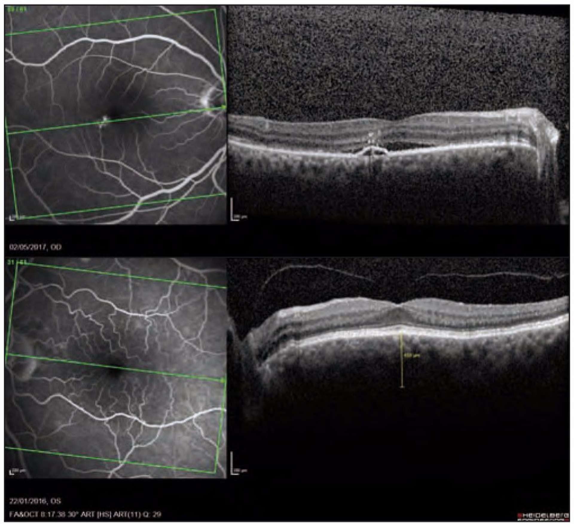 Figure 2. OCT B-scan d’un patient présentant une CRSC chronique de l’œil droit. Sur l’œil adelphe (en bas), on peut voir la présence d’anomalies kystiques péripapillaires sans imprégnation à l’angiographie à la fluorescéine.
