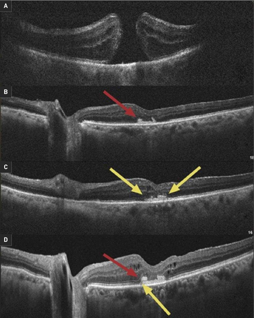 Figure 2. Trou maculaire persistant après chirurgie conventionnelle opéré par vitrectomie avec greffe de membrane amniotique (A). À 1 mois postopératoire le trou maculaire est fermé et la membrane amniotique est visible à la face postérieure de la rétine (B). À 3 mois postopératoire les couches rétiniennes internes sont individualisables (C). À 6 mois postopératoire les couches rétiniennes internes et externes sont individualisables (D).
