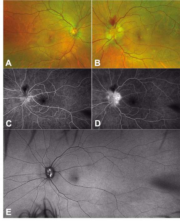 Figure 1. Patiente de 41 ans avec une neuropathie ischémique antérieure aiguë de l’œil gauche, compliquant des drusen papillaires. A et B. Les photographies couleur ultra-grand champ Optos montrent un œdème papillaire de l’œil gauche, associé à des hémorragies suprapapillaires. C et D. L’angiographie à la fluorescéine ne montre pas de retard circulatoire, mais une diffusion papillaire au temps tardifs (D). Le cliché en autofluorescence montre des drusen papillaires au niveau de l’œil gauche.
