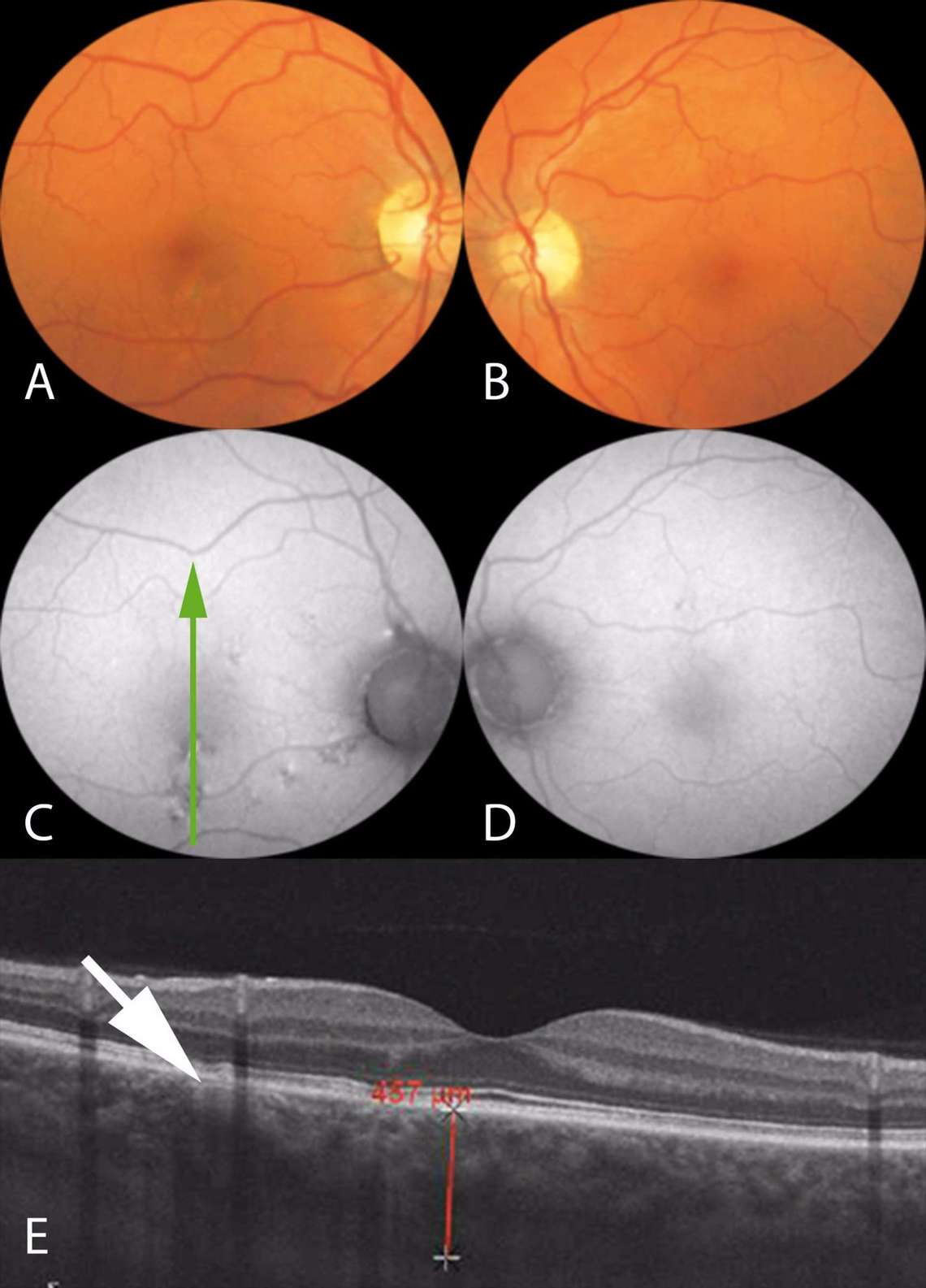 Figure 1. Imagerie multimodale d’un patient de 45 ans ayant consulté pour des métamorphopsies modérées de l’œil droit sans baisse d’acuité visuelle, avec rétinophotos couleur (A, B), clichés en autofluorescence (C, D) et coupe verticale fovéolaire en OCT en mode EDI de l’œil droit (E). Au niveau de l’œil droit, on note des migrations pigmentaires inféromaculaires sur le cliché couleur (A), hyper-autofluorescentes (B), qui correspondent à des irrégularités minimes des couches profondes en OCT au niveau d’un pachyvaisseau choroïdien (flèche blanche, E). L’épaisseur choroïdienne fovéolaire est mesurée à plus de 450 microns. Au niveau de l’œil gauche, le patient présentait un fond d’œil sans anomalie significative en couleur ou en autofluorescence (B, D) et une pachychoroïde sur l’OCT (non montrée).
